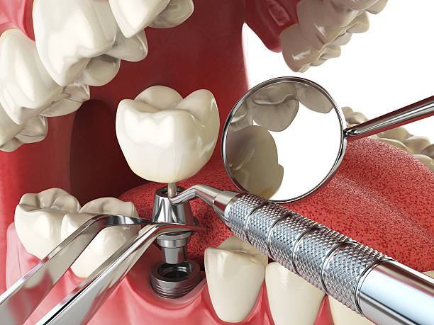 Best Emergency Dental Care for Abscessed Tooth in Breckenridge Hills, MO